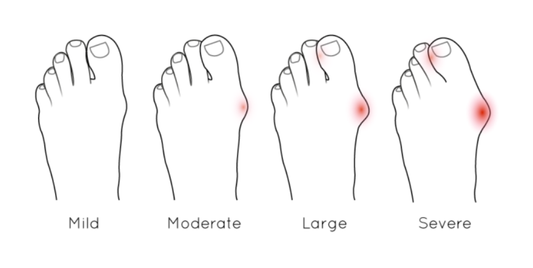How to Fix Bunions Without Surgery